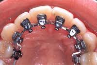 appareil-dentaire-lingual
