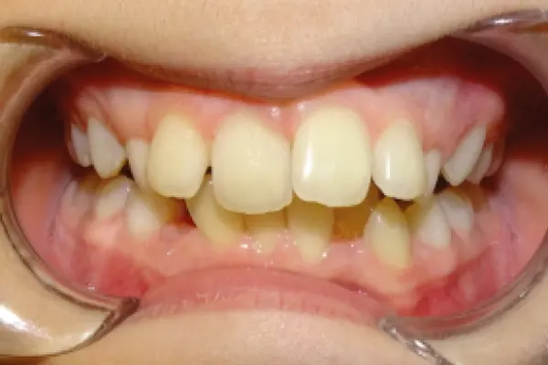 Chevauchement dentaire