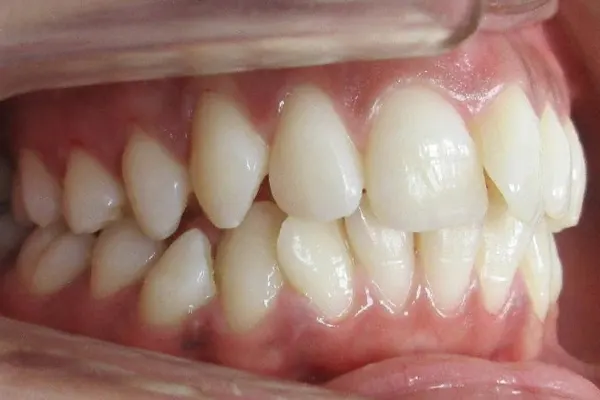 Dysharmonie dento maxillaire